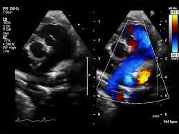 pediatric-echo