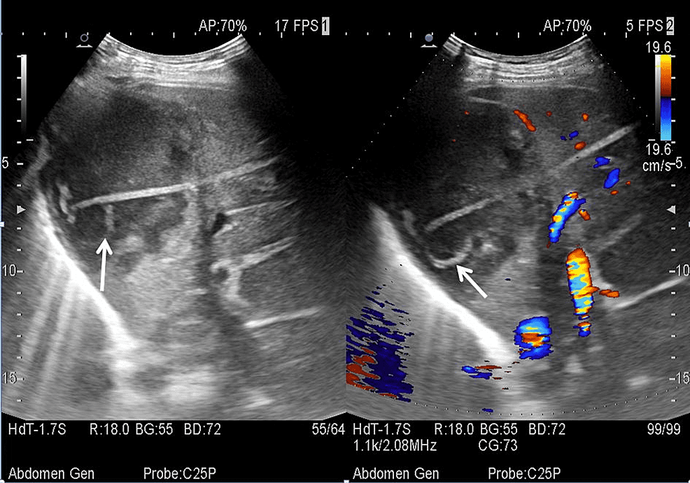 catheter-drainage