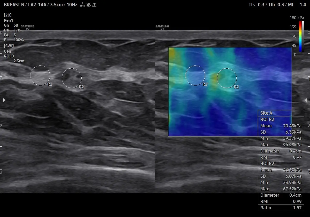 Breast Elastography