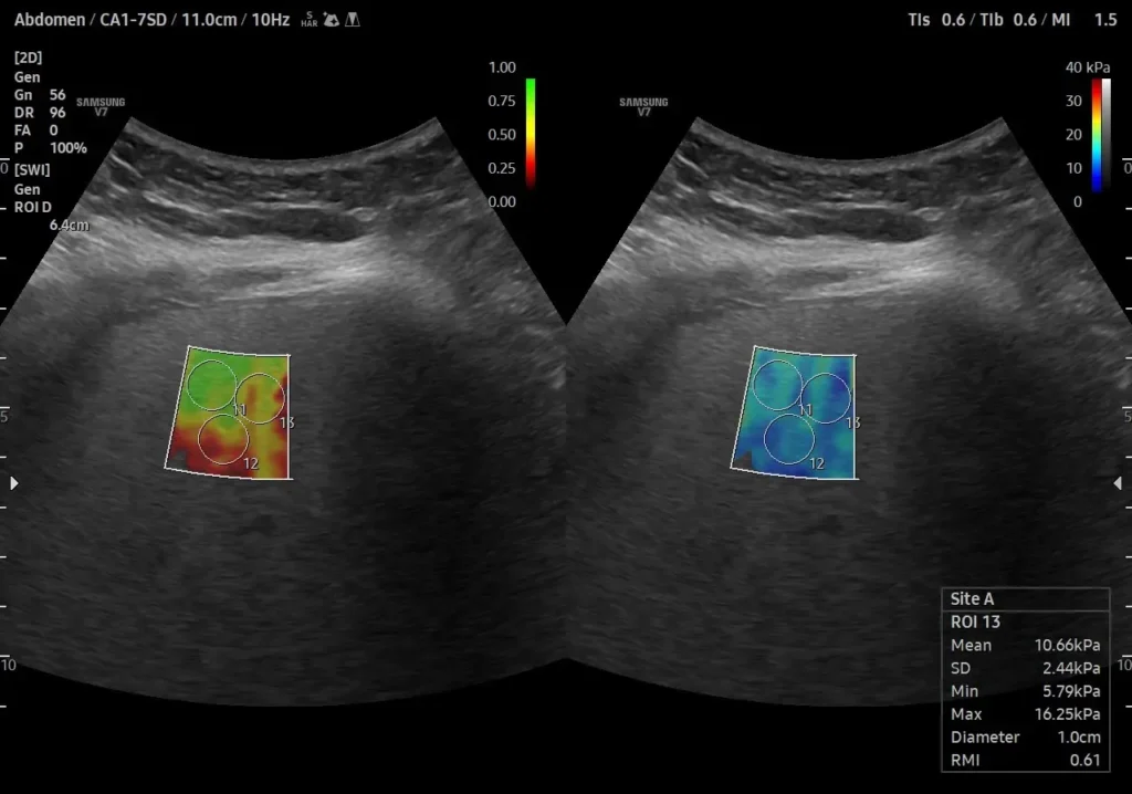 Breast Elastography